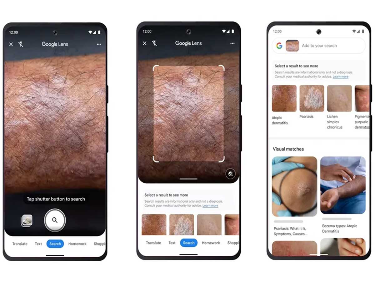 Google says Lens can identify skin conditions from a photograph